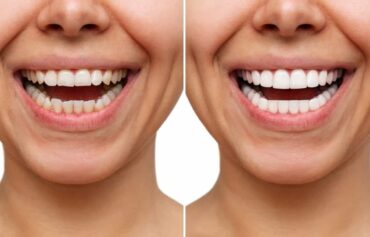 Professional Teeth Whitening