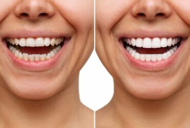 Professional Teeth Whitening