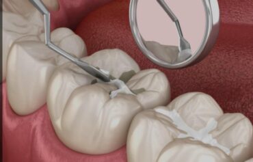 Dental Sealants