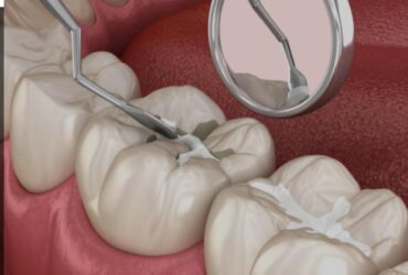 Dental Sealants